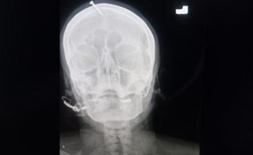 巴基斯坦一妇女为了想生男孩，将钉子钉入头部，此举有何安全风险？