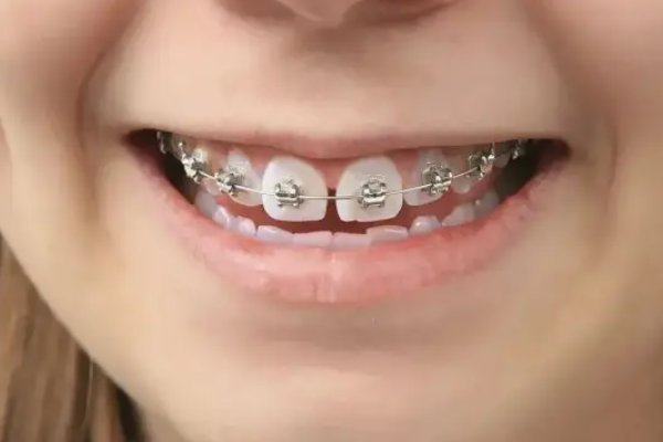 有些家长让三岁孩子每天戴牙套12小时,是谁在贩卖焦虑呢?