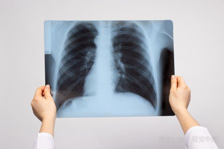 肺结节怎么治？