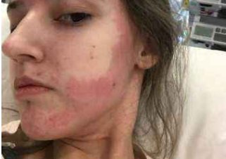 英国一女子对所有食物过敏，这种情况如何进食？