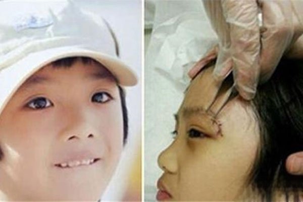 费曼眼睛怎么伤的 打闹的时候被推到磕在了桌角上